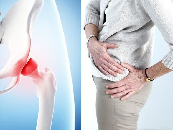 signs of osteoarthritis of the hip joint