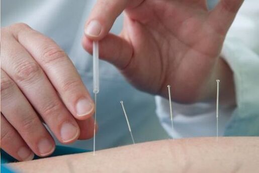 Acupuncture is a method of treating back pain caused by osteochondrosis