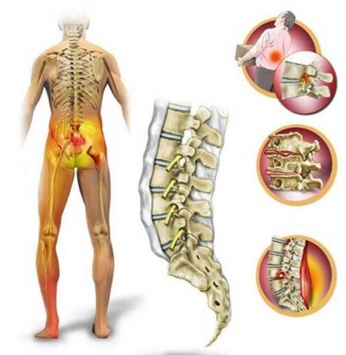 Osteochondrosis of the lumbar spine causes back pain