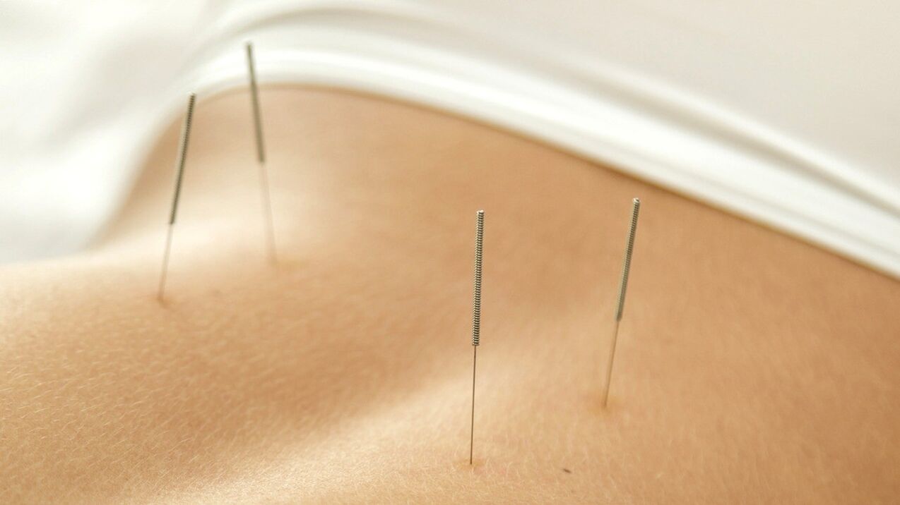Acupuncture will help you get rid of back pain
